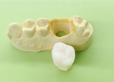 画像：歯と歯茎の模型と、白い材料で作られた歯